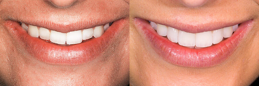 Before: Inadequate tooth length and uneven smile<br />After: Tooth contours modified with porcelain veneers