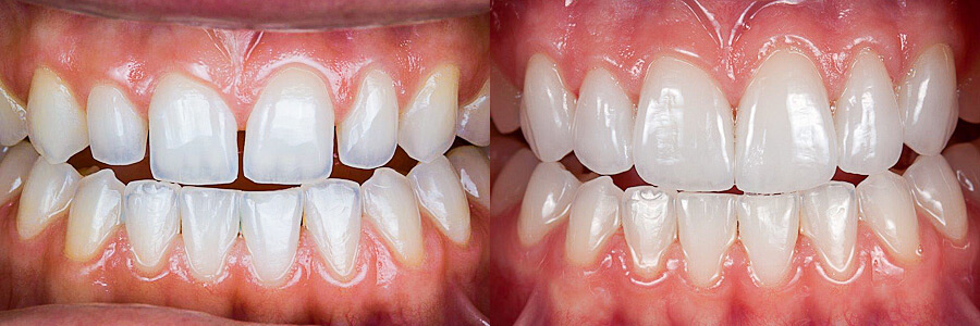 Before: Interproximal spaces and undersized teeth<br />After: Spaces closed with porcelain veneers