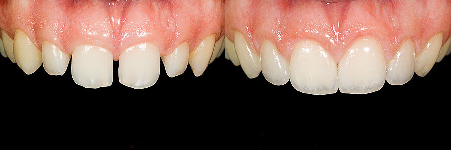 Before: Undersized teeth and interproximal spaces<br />After: Spaces closed with porcelain veneers