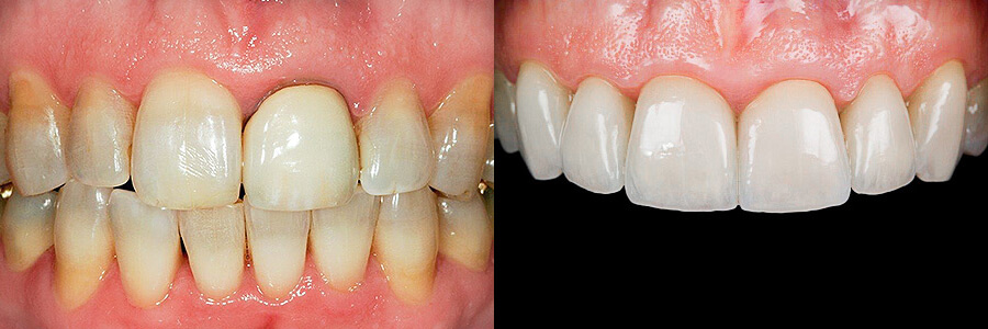 Before: Discolored and abraded teeth<br />After: Restored with porcelain veneers and porcelain crowns