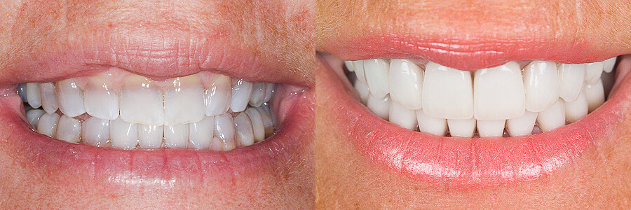 Before: Tetracycline staining<br />After: Porcelain veneers to mask discoloration