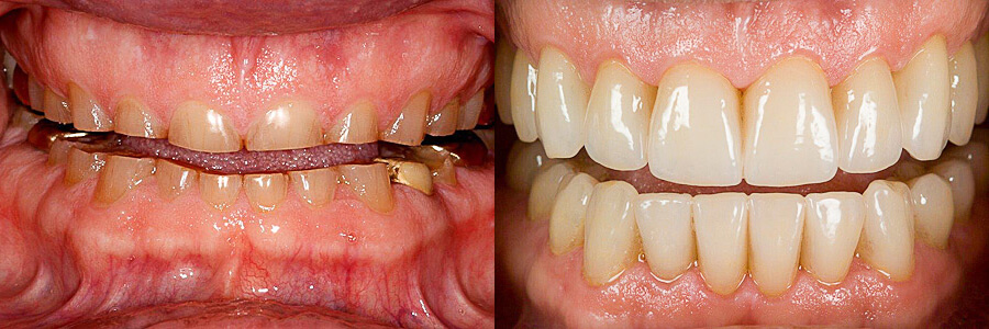 Before: Severe tooth wear and discoloration<br />After: Dental rehabilitation with porcelain crowns