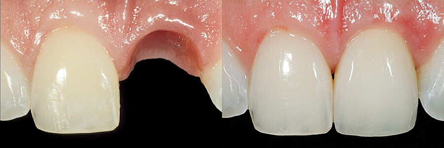 Before: Fractured upper central incisor<br />After: Restored with a single implant crown
