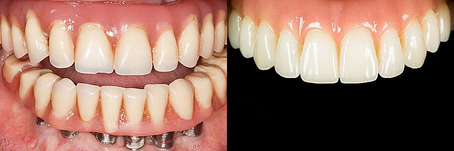 Before: Failing Implant Bridge<br />After: Replacement Implant Bridge
