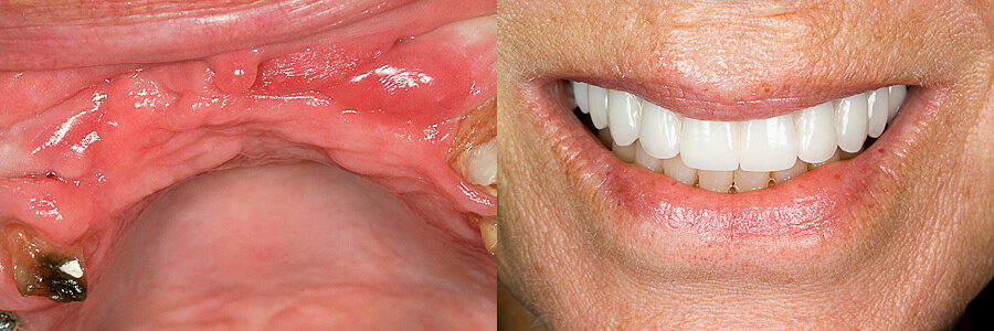 Before: Multiple missing anterior teeth<br />After: Restored with an implant bridge and single crowns